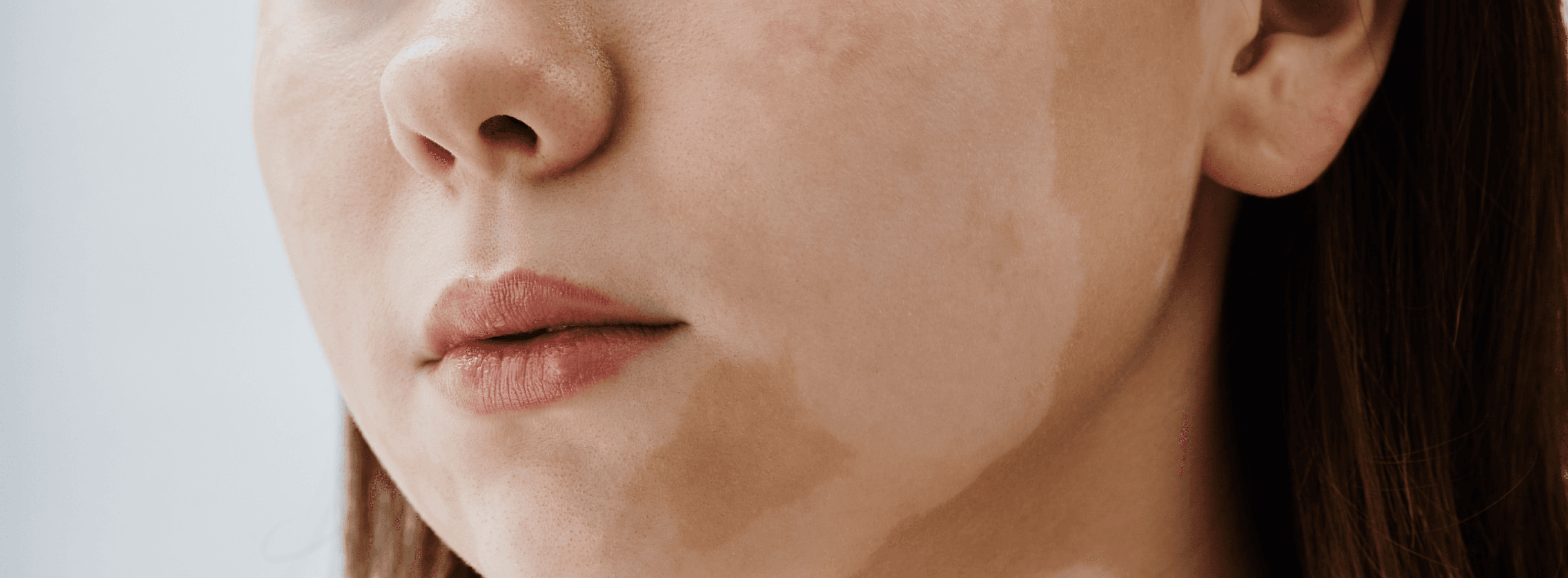 Dermatological Diseases