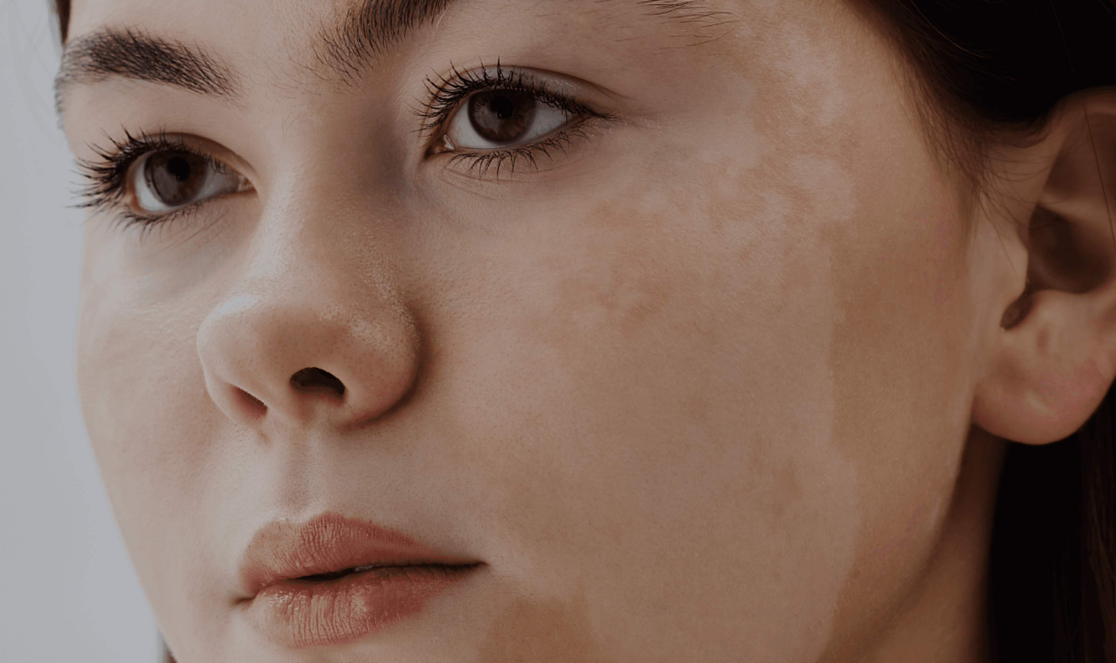 Dermatological Diseases